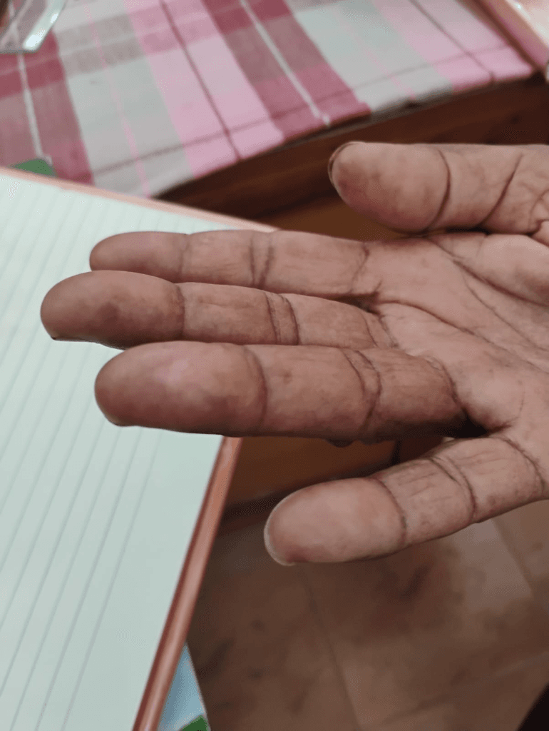 Chronic Non-Healing Finger Ulcer & Tissue Recovery - After Homeopathy Treatment
