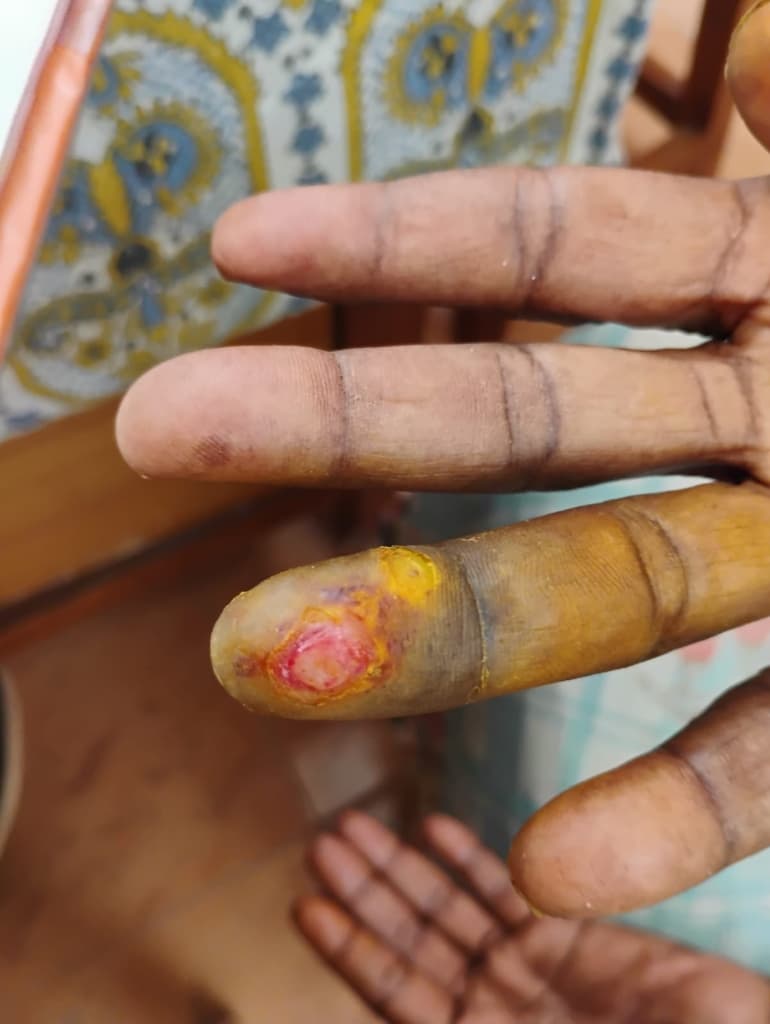 Chronic Non-Healing Finger Ulcer & Tissue Recovery - Before Homeopathy Treatment