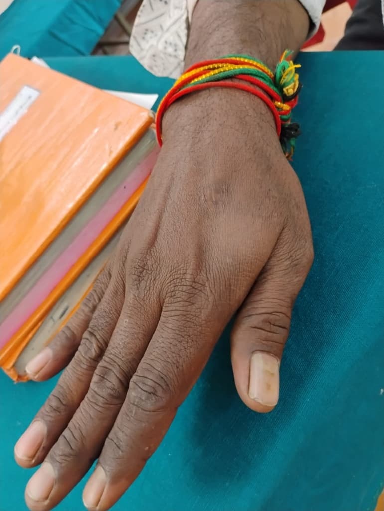 Extensive Hand Warts (Verruca Vulgaris) Clearance - After Homeopathy Treatment