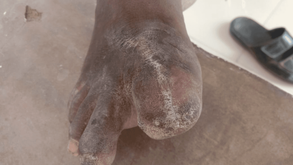 Severe Chronic Foot Ulcer & Tissue Re-Epithelialization - After Homeopathy Treatment