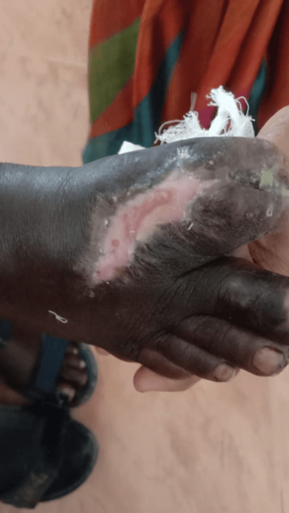 Severe Chronic Foot Ulcer & Tissue Re-Epithelialization - Before Homeopathy Treatment