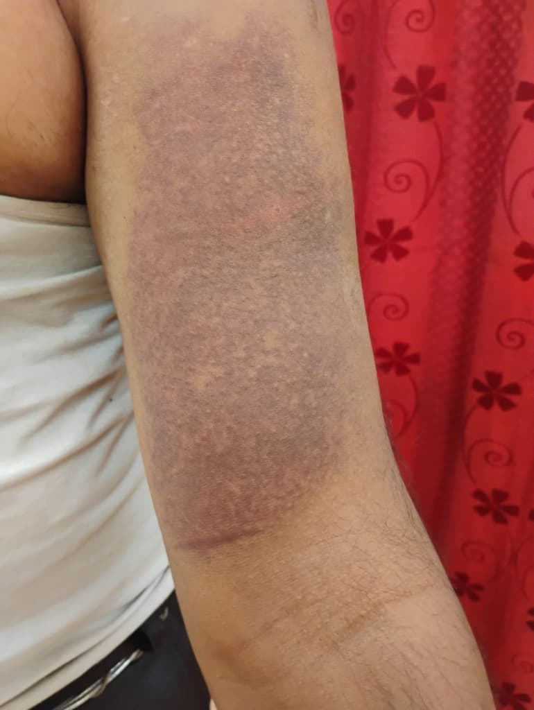 Extensive Hyperpigmented Eczema & Lichenoid Plaque - Before Homeopathy Treatment