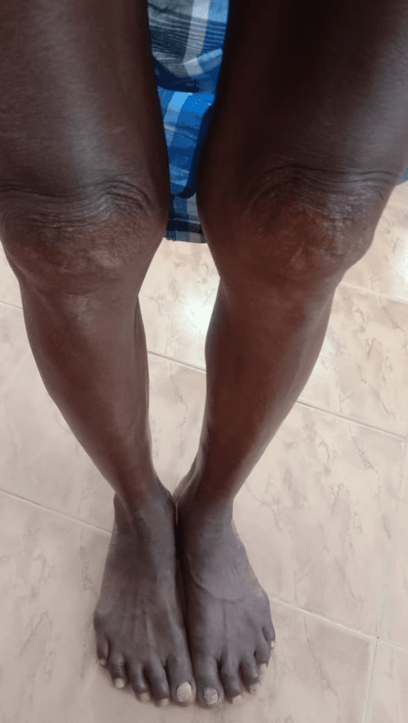 Severe Knee Arthritis, Joint Effusion & Mobility Restored - After Homeopathy Treatment