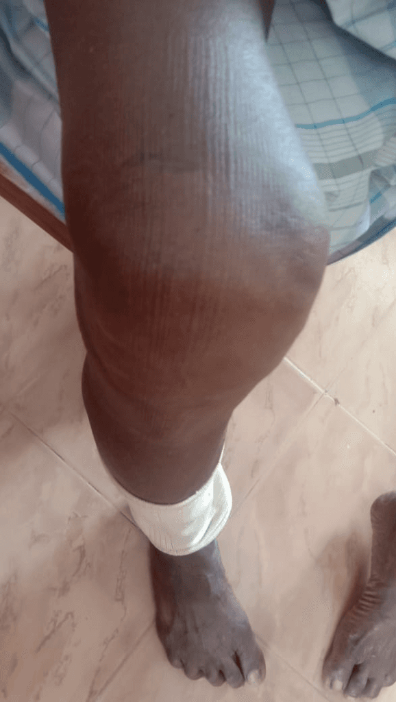 Severe Knee Arthritis, Joint Effusion & Mobility Restored - Before Homeopathy Treatment